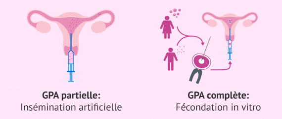 GPA partielle et GPA complète