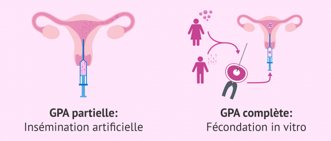 GPA partielle et GPA complète