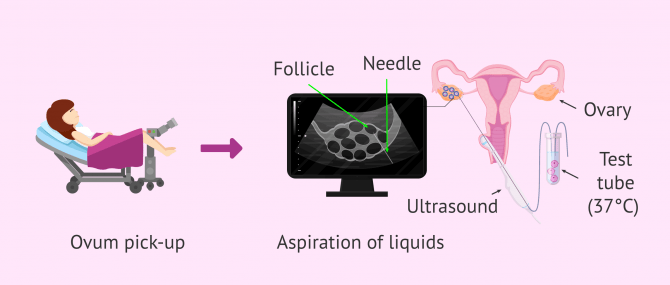 Imagen: Ovum pick-up step by step
