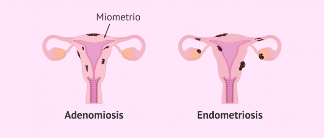 Imagen: Útero con adenomiosis y útero con endometriosis