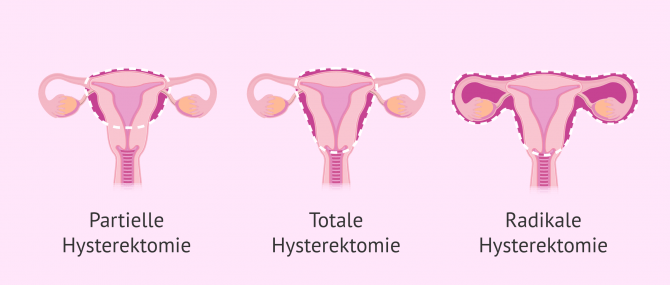 Imagen: Gebärmutterentferung