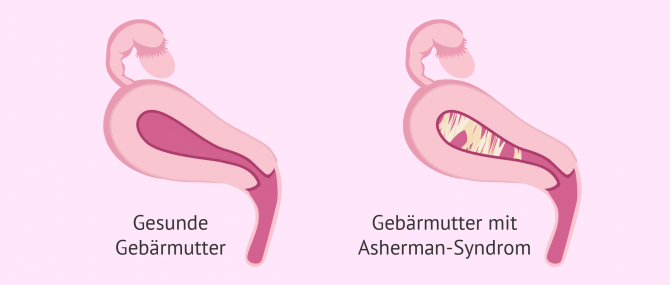 Imagen: Gesunde Gebärmutter und verklebte Gebärmutter