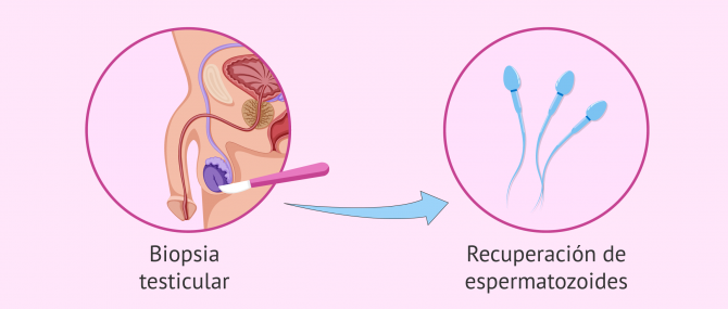 Imagen: Biopsia de testículo para comprobar la producción de espermatozoides