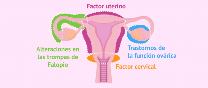 Imagen: Principales causas de esterilidad femenina