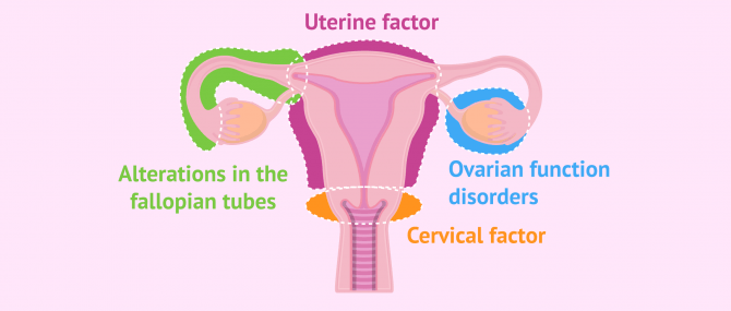 Imagen: Main causes of female sterility