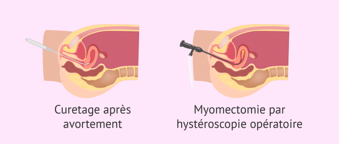 Causes possibles des synéchies utérines