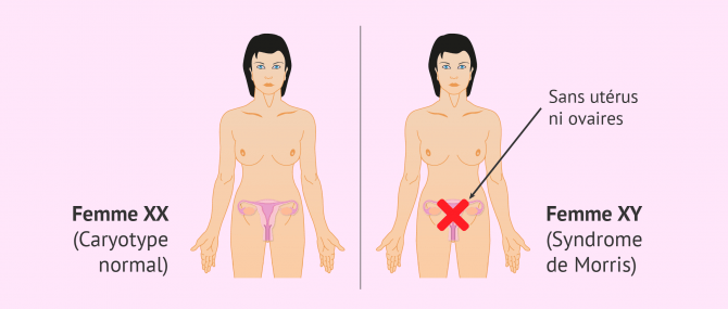Imagen: comparaison avec et sans syndrome de Morris