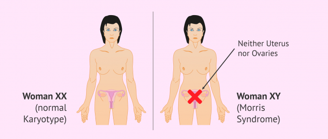 Imagen: characteristics of women with Morris syndrome