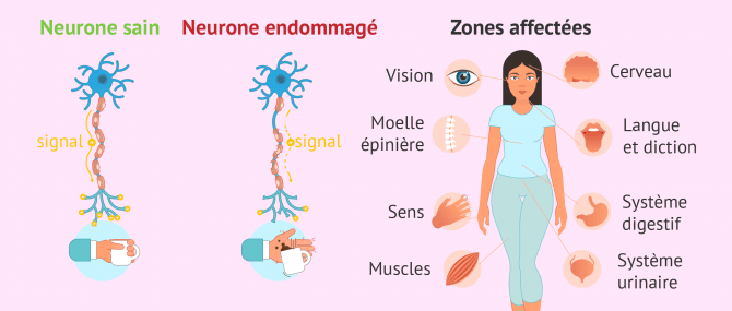 Imagen: symptômes sclérose en plaque