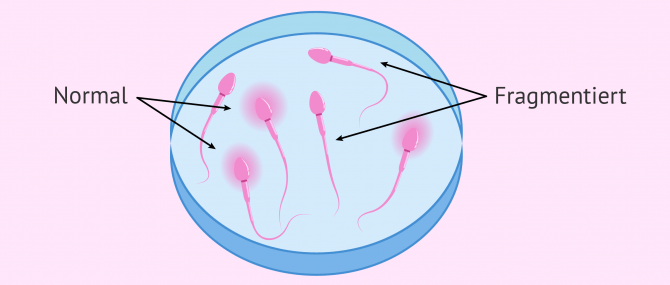 Imagen: DNA-Fragmentierung der Spermien