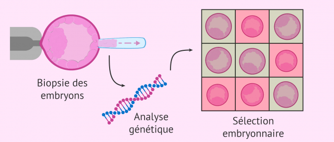 DPI pour éviter l'échec de l'implantation de l'embryon