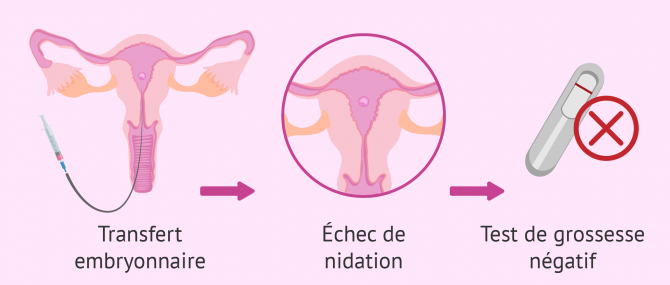 Échec de nidation après une FIV