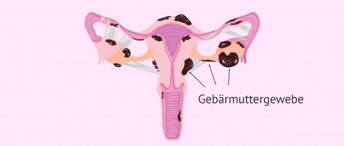 Imagen: Schwere Endometriose mit Zysten und Endometriome