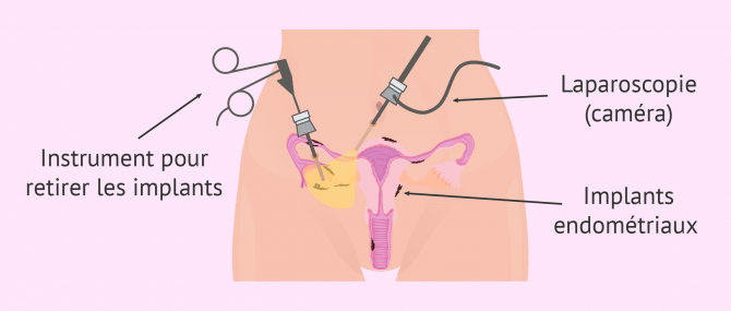 Imagen: endometriose laparoscopie