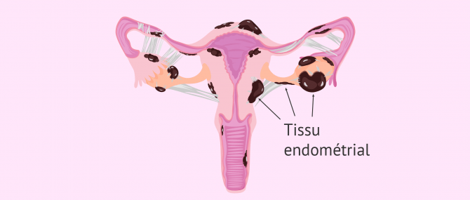 Endométriose sévère avec kystes endométriosiques