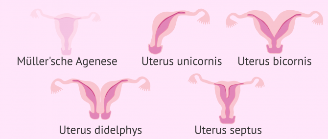 Imagen: Fehlbildungen im Uterus