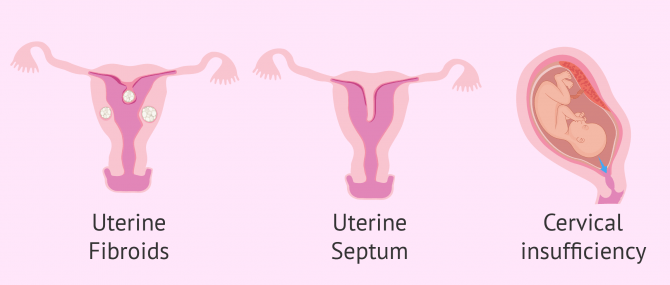 Imagen: Uterine malformation miscarriage