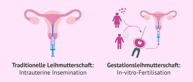 Imagen: Traditionelle und gestationelle Leihmutterschaft