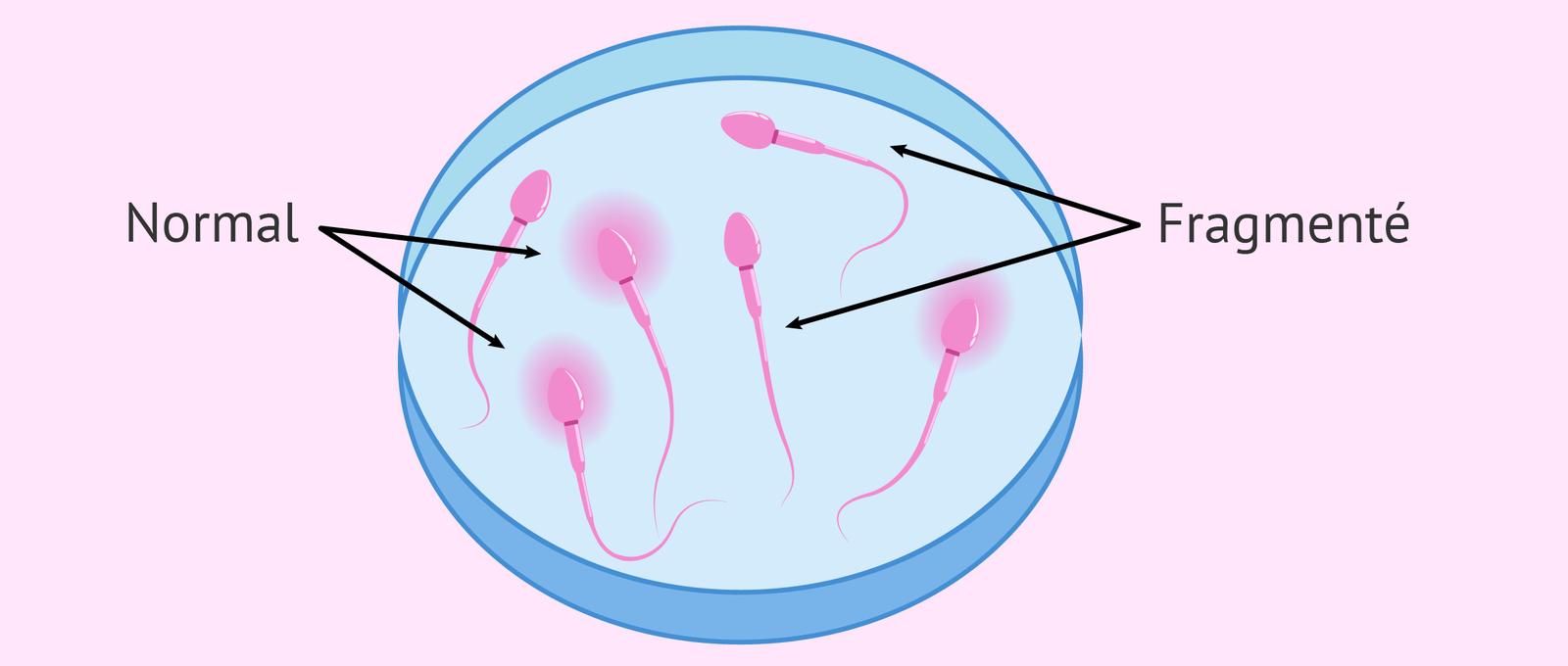 Imagen: Fragmentation ADN Sperme