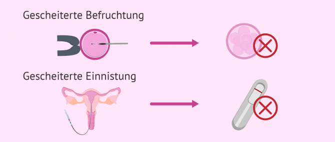 Imagen: Fehler bei der In-vitro-Fertilisation