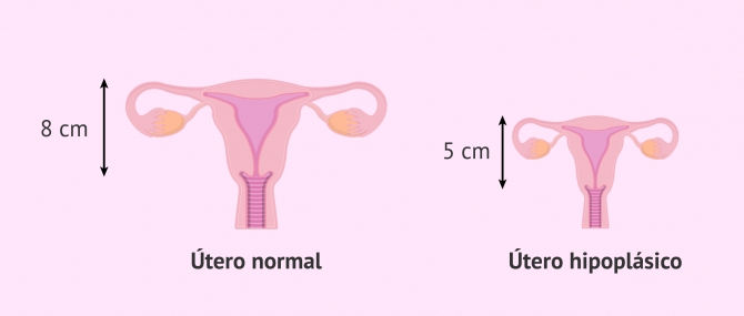 Imagen: ¿Qué es la hipoplasia uterina?