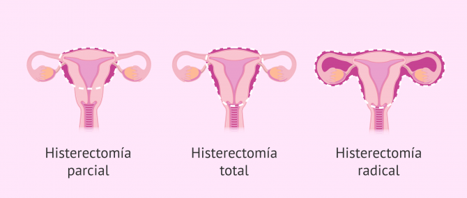 Imagen: Tipos de histerectomía
