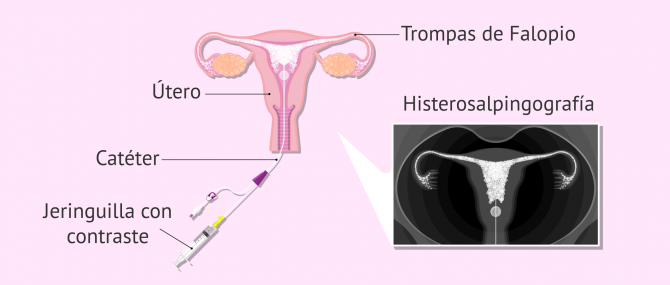 Imagen: Histerosalpingografia para analizar la permeabilidad tubárica