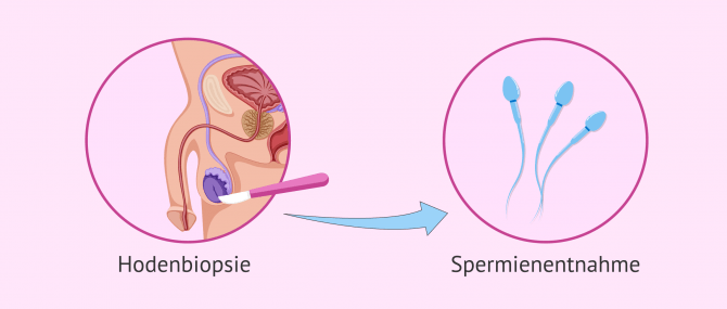 Imagen: Hodenbiopsie zur Überprüfung der Spermienproduktion