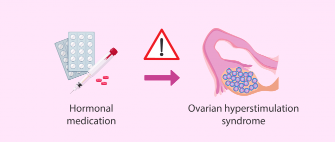 Imagen: hyperestimulation sindrome