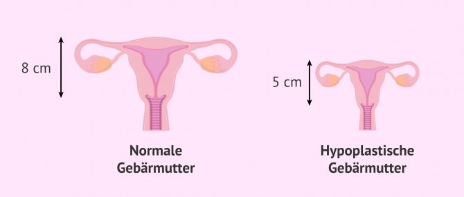 Imagen: Hyperplastische Gebärmutter