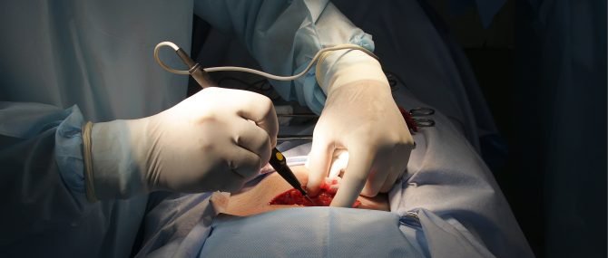 Hystérectomie en cas de cancer de l'utérus