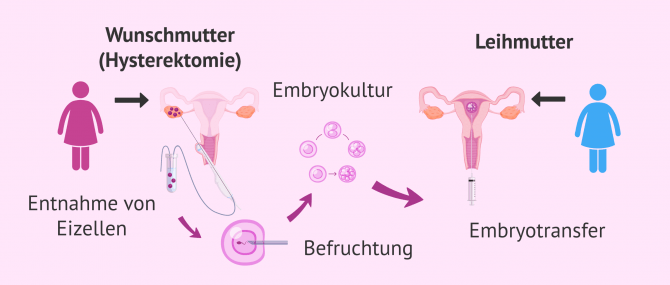 Imagen: In-vitro-Befruchtung mit eigenen Eizellen