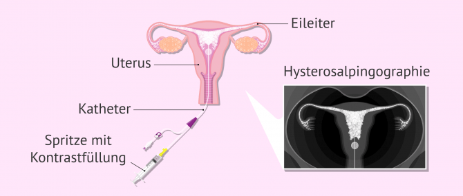 Imagen: Hysterosalpingographie zur Analyse der Eileiterdurchgängigkeit