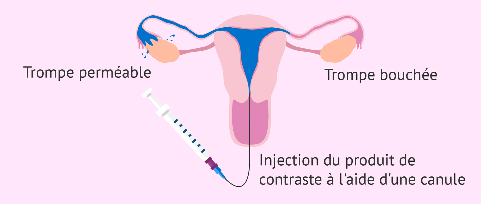 Imagen: Hystérosalpingographie(HSG)