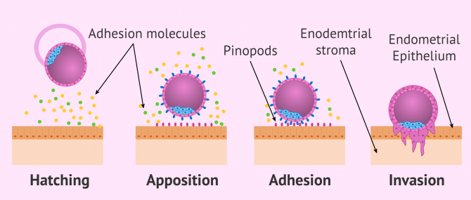Imagen: Implantation process