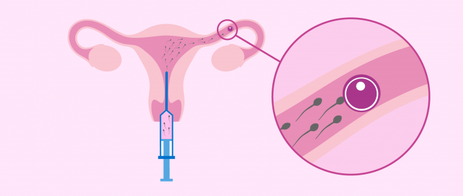 Inseminación artificial en gestación subrogada