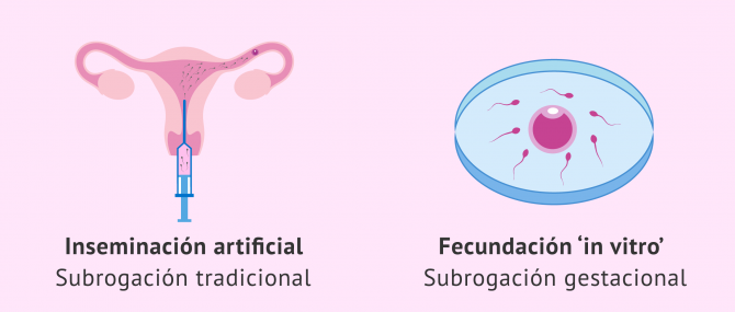 Técnicas de reproducción asistida en maternidad subrogada