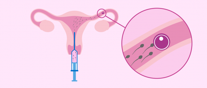 IUI in surrogacy
