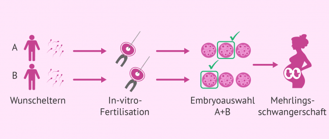 Imagen: IVF in der Leihmutterschaft bei schwulen Paaren