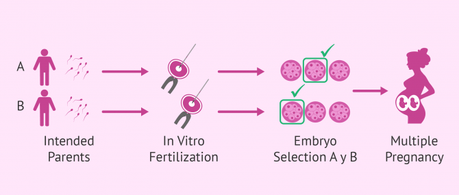 Imagen: IVF multiple pregnancy