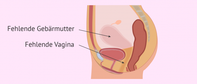 Imagen: Küster-Hauser-Syndrom