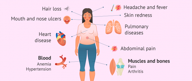 Imagen: lupus symptoms
