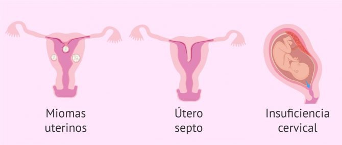 Imagen: Presencia de miomas
