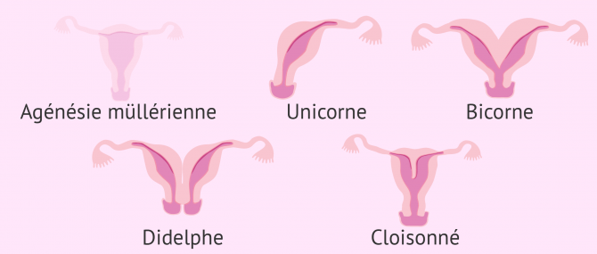Malformations utérines congénitales