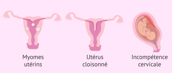 Malformations utérines responsables de fausses-couches à répétition