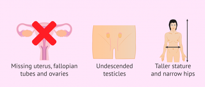 Imagen: Symptoms and characteristics of Morris syndrome
