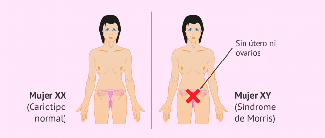 Imagen: Características de la mujer con síndrome de Morris