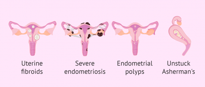 Müllerian duct anomalies and uterine diseases