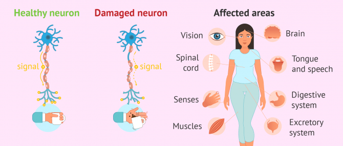 Imagen: multiple sclerosis