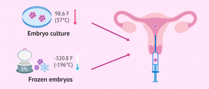 Imagen: Fresh or frozen embryo transfer